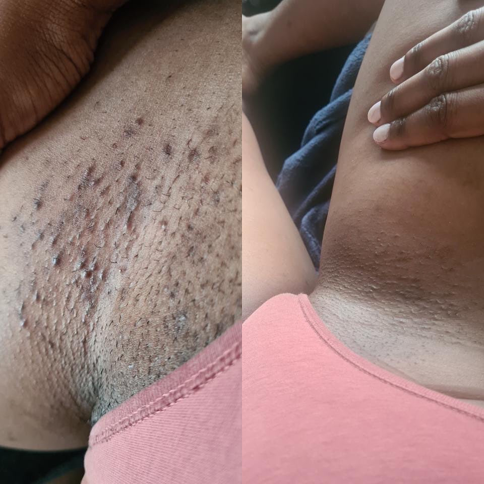 FADE lotion